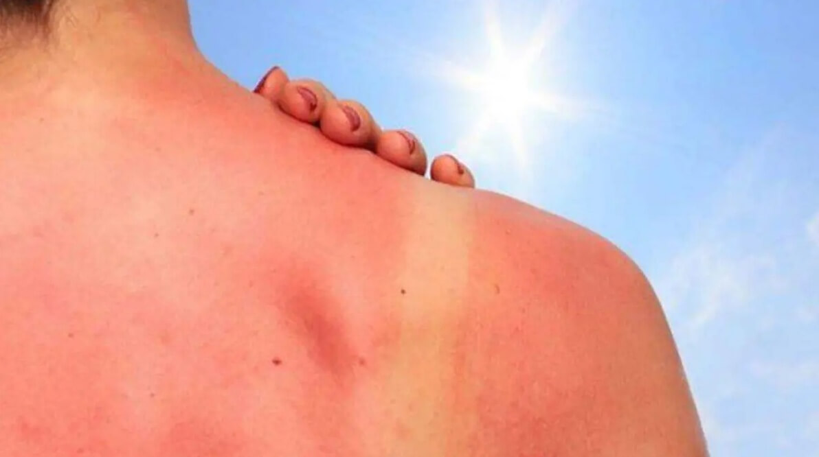 Five alence in summer season that best can prevent cure